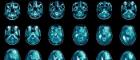 Multiple scans of gioblastoma cancer